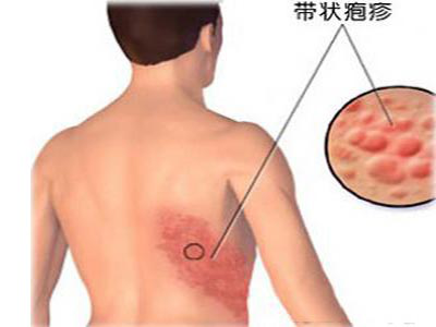 带状疱疹神经痛熬一熬就真的能过去吗？