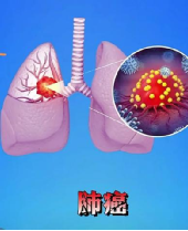 50岁晚期肺癌患者已存活近十年，中西医结合创抗癌奇迹